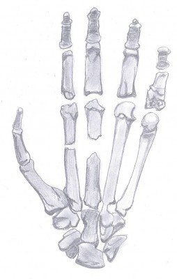 fracture