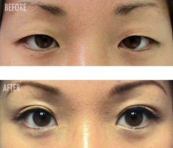 eyelid